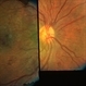 Neovascularization
